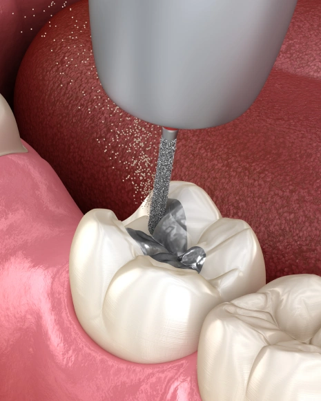 Cavity Fillings and Dental Sealants
