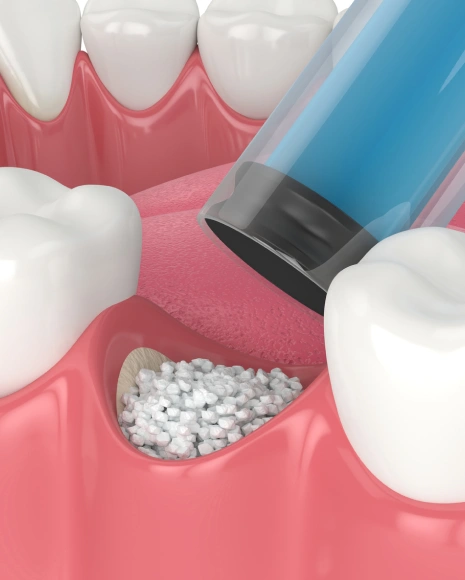 Dental Bone Grafting