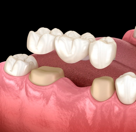 Dental Crowns and Bridges
