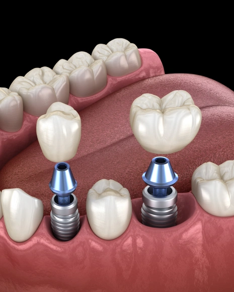 Dental Implants